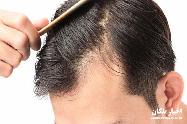کمبود کدام ویتامین‌ها سبب ریزش مو می‌شود؟